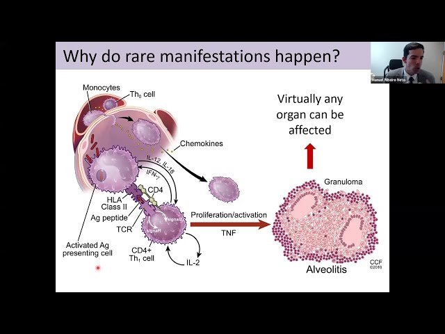 Rare Manifestations of Sarcoidosis
