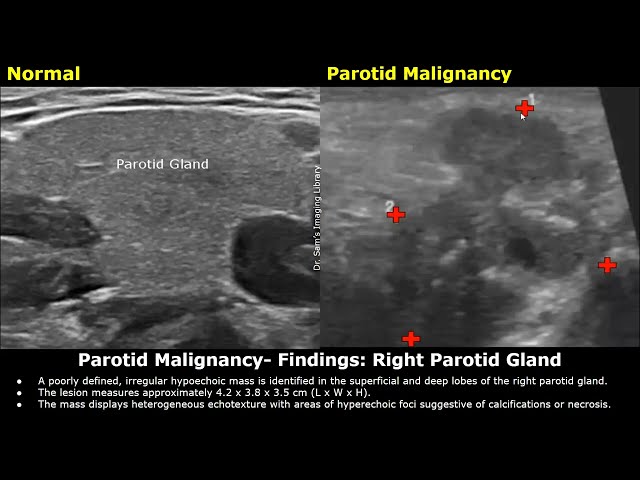 Salivary Glands Ultrasound Reporting - Diagnosis and Pathology Cases