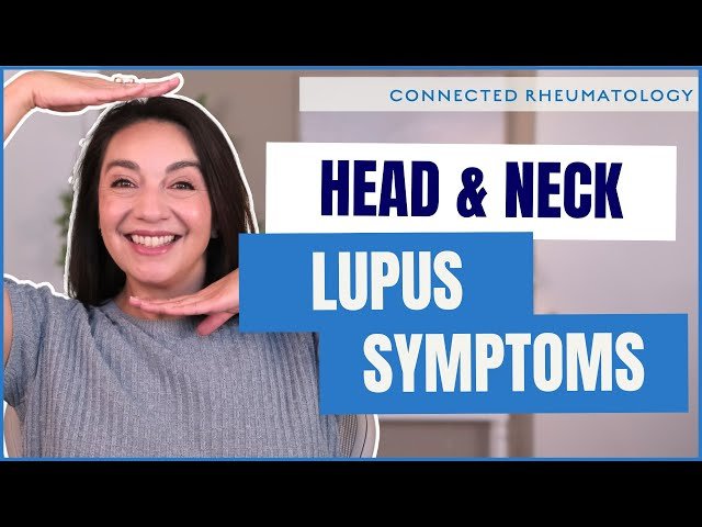 Above the Shoulders Lupus Symptoms Your Doctor May Miss