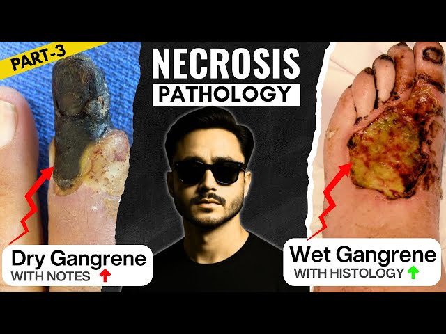 Dry Gangrene, Wet Gangrene, and Gas Gangrene - Cell Injury Pathology