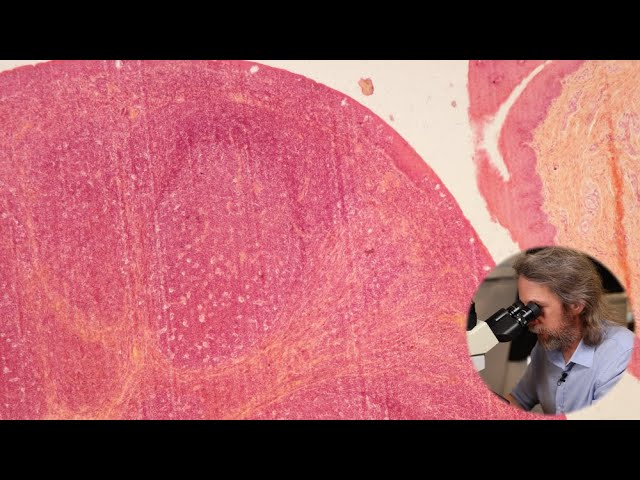 Histology of the Tonsil - Understanding Tonsillitis Through Microscopic Analysis