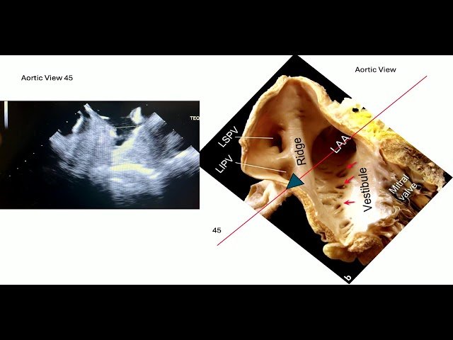 Evaluation of the LAA: Rule Out Thrombi, Measurement for LAAO, CT Assessment