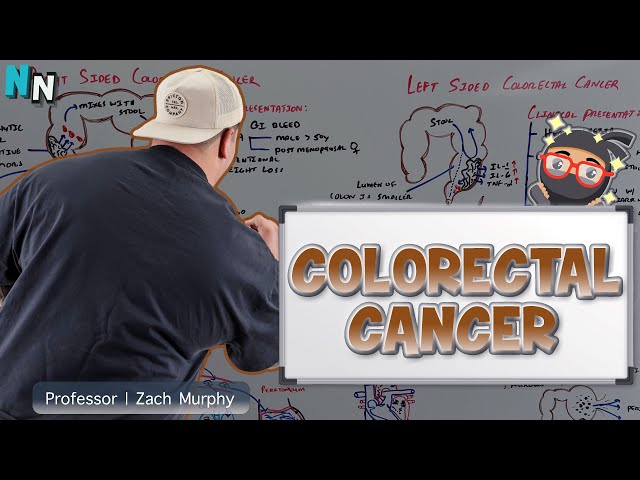 Colorectal Cancer - Clinical Medicine