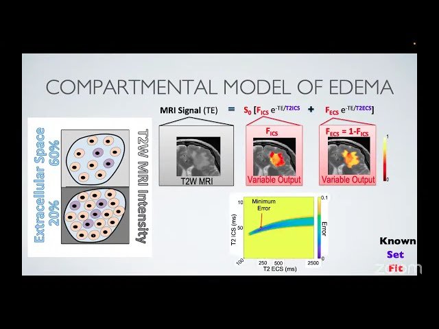 Sex-Distinct Transcriptomic Signatures Underlie MRI-Defined Edema Patterns in GBM