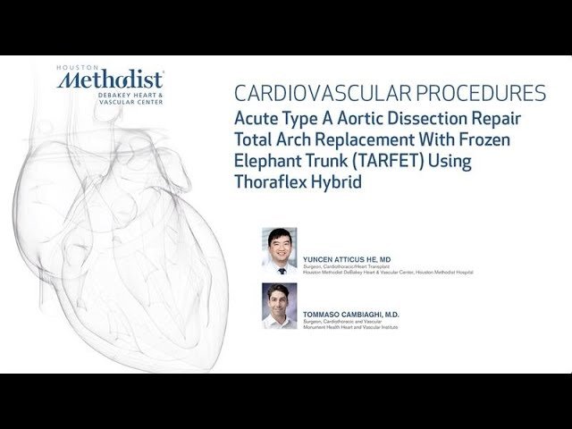 Acute Type A Aortic Dissection Repair - TARFET Using Thoraflex Hybrid