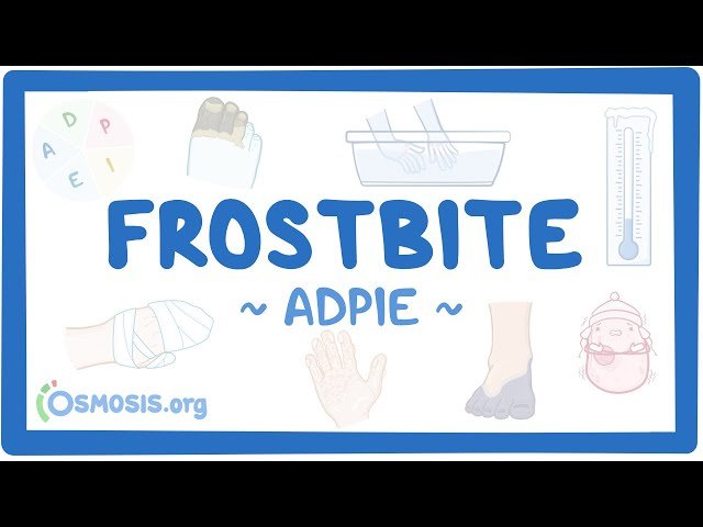 Frostbite - Nursing Process (ADPIE)