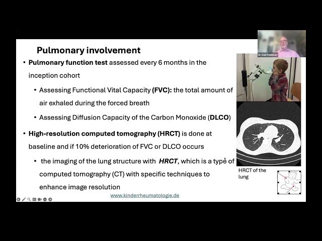 How to Assess Activity in Juvenile Systemic Scleroderma