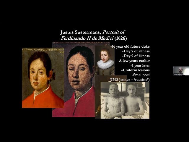 Did Caravaggio Catch Malaria? - Diagnosing Infectious Disease in Artwork