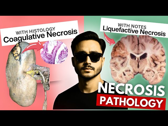 Necrosis Cell Injury Pathology - Coagulative Necrosis and Liquefactive Necrosis
