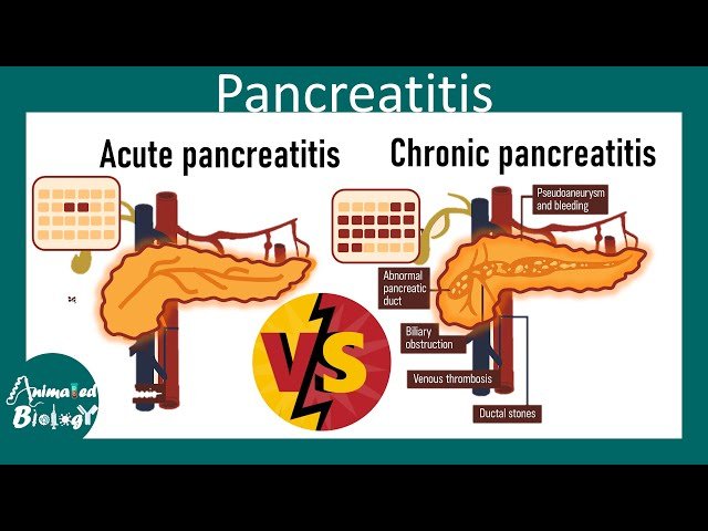 Acute vs Chronic Pancreatitis - Detailed Pathology and Treatment Options