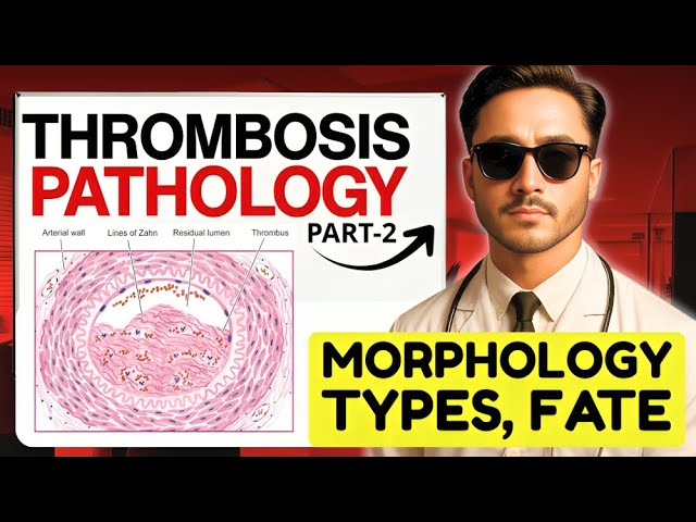 Thrombosis General Pathology - Types, Morphology, and Fate of Thrombosis