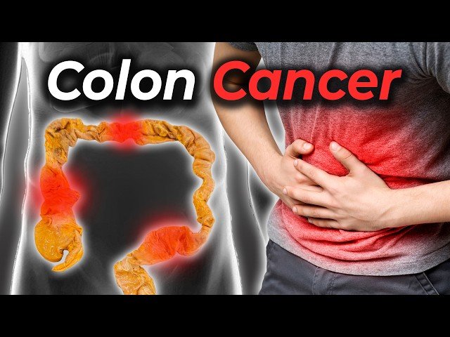 Colon Cancer Screening and Prevention - Anatomy, Symptoms, and Early Detection