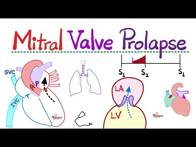 Mitral Valve Prolapse and Mitral Regurgitation - Valvular Heart Disease in Cardiology