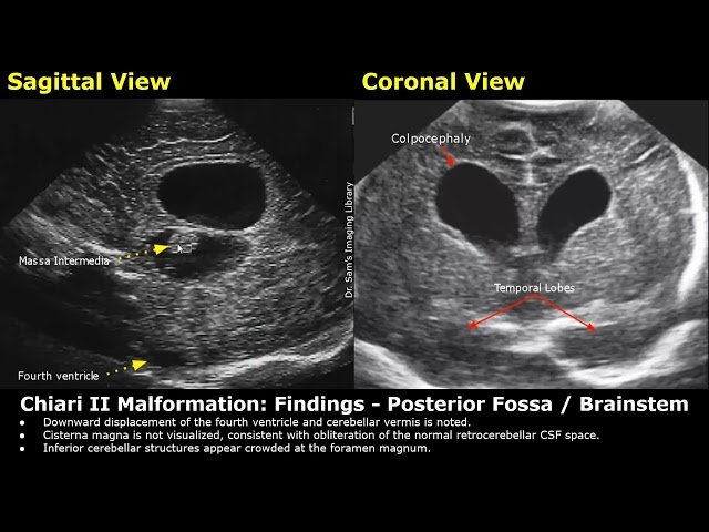 Neonatal Brain Ultrasound Reporting - Full Term Infant and Premature Newborn Head USG Report Examples