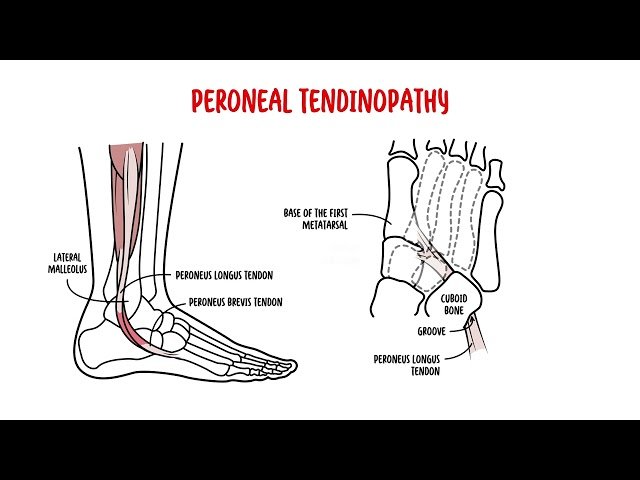 Lateral Ankle Pain - Anatomy and Causes of Pain in the Outer Part of the Ankle
