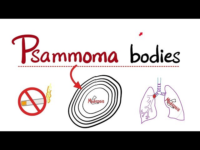 Psammoma Bodies - Concentric Laminated Dystrophic Calcification in Malignancy
