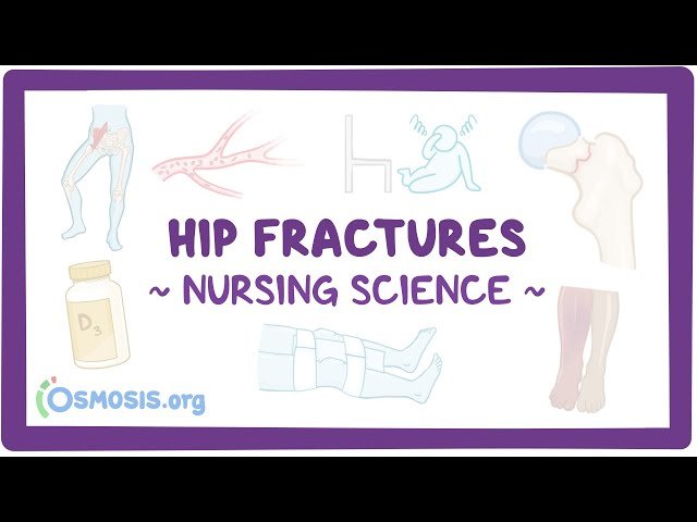 Hip Fractures - Clinical Nursing Care