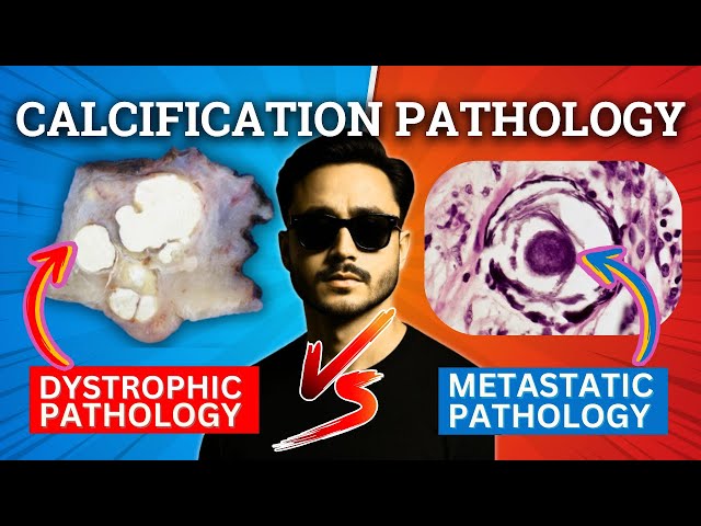 Calcification Pathology - Dystrophic and Metastatic Calcification and Calcium Accumulation