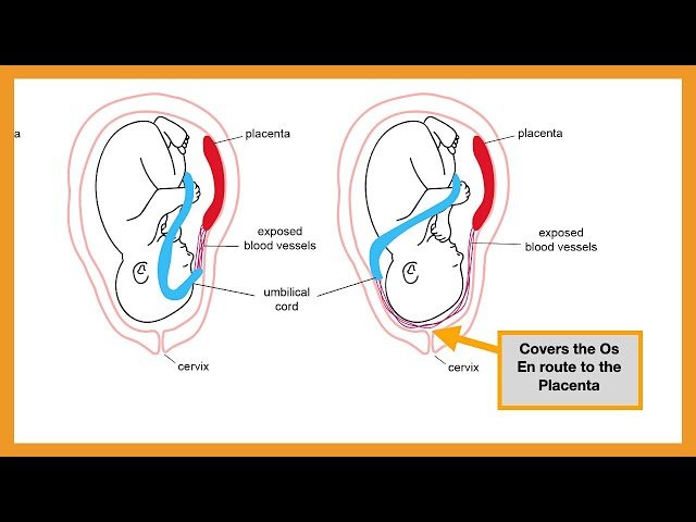 Placenta Pathology - Abruptio Placentae, Placenta Accreta/Increta/Percreta, Placenta/Vasa Previa