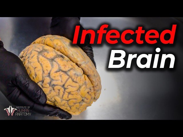 Rabies - One of the Most Deadly Viruses