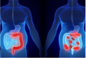 IBD-U APP Educational Seminar Series: Disease States in Inflammatory Bowel Disease