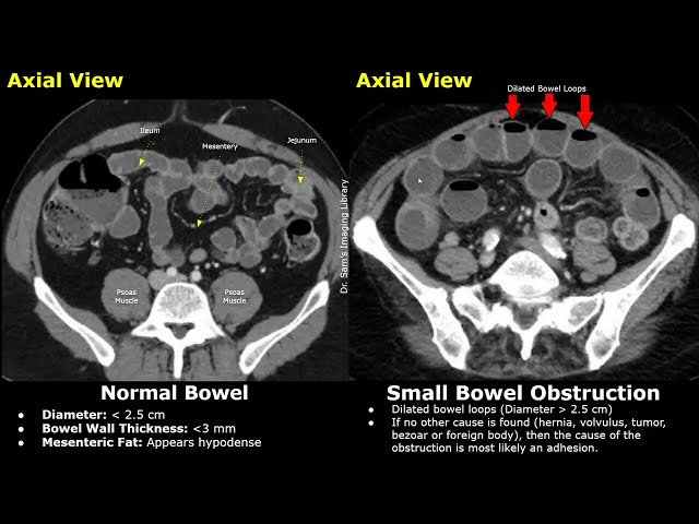 CT Abdomen - Normal Bowel vs Small Bowel Obstruction: Adhesions, Volvulus, Hernia and Other Causes