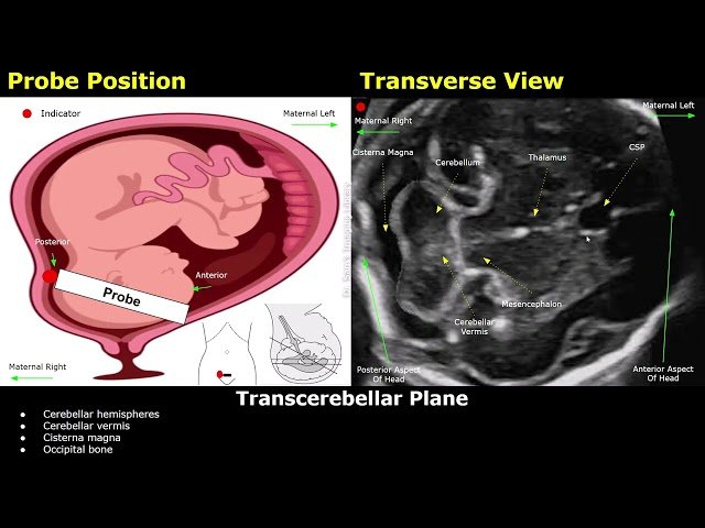 Fetal Brain Ultrasound Probe Position and Scanning Technique - TAS Axial, Coronal and Sagittal Planes