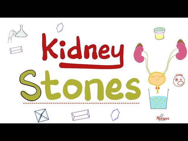 Kidney Stones and Urine Crystals - Crystalluria