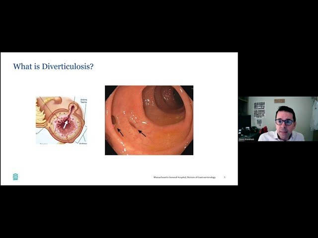 Signs, Symptoms, and Management of Diverticulitis