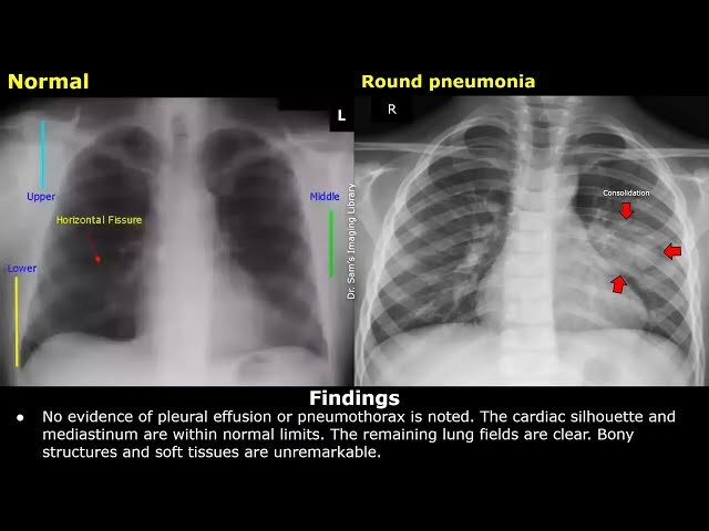How to Write Chest X-Ray Reports for Pneumonia Cases - Clinical History, Findings and Impression