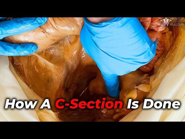What Actually Happens During a C-Section?