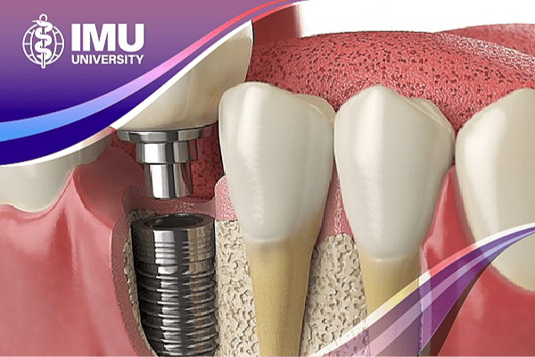 Dental Implantology (Straumann® SMART): Advancing Clinical Practice Through Implant Dentistry