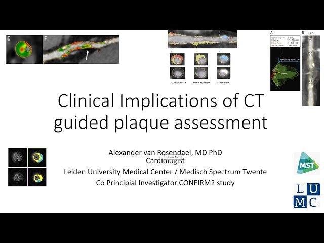 Clinical Implications of CT Guided Coronary Plaque Evaluation