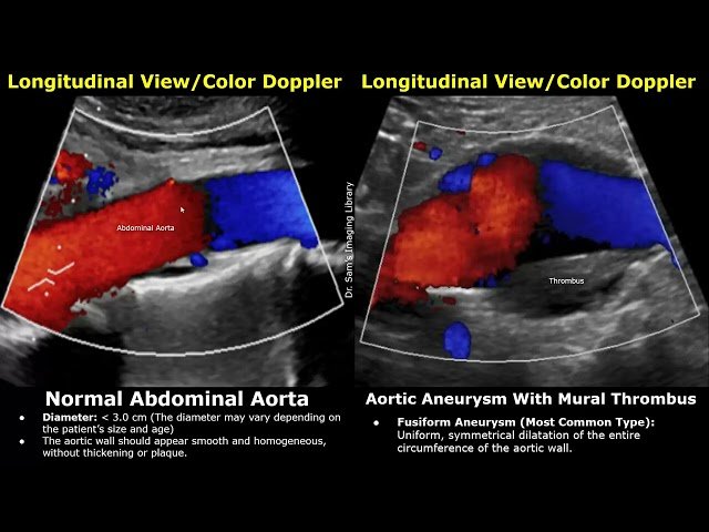 Abdominal Aorta Doppler Ultrasound - Normal and Abnormal Conditions: Aneurysm, Dissection, Stenosis and Rupture