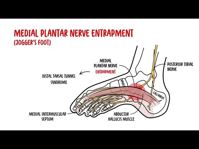 Medial Ankle Pain - Inner Ankle Pain
