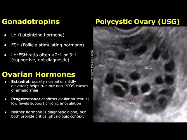 Polycystic Ovarian Syndrome Specific and Supportive Lab Tests for Diagnosis - PCOS Clinical Findings