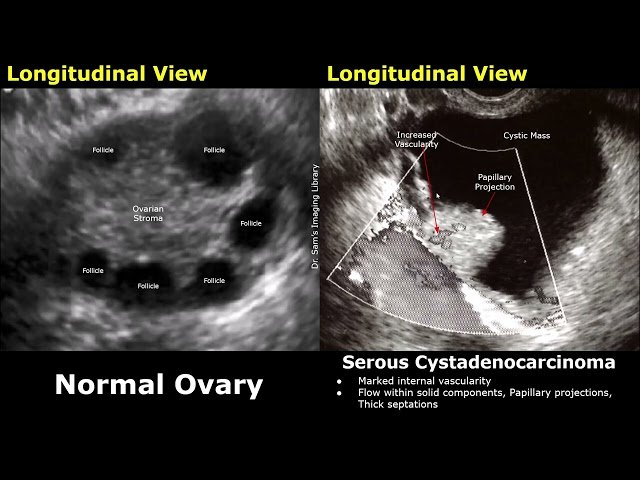 Gynecological Ultrasound - Ovary Normal vs Serous Cystadenocarcinoma and Ovarian Cancer USG Findings