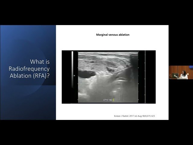 Radiofrequency Ablation of Thyroid Nodules - Current Indications and Future Considerations