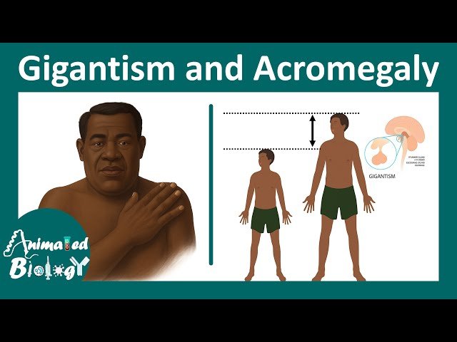 Acromegaly vs Gigantism - Growth Hormone Disorders Explained in 10 Minutes