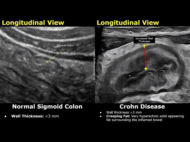 Bowel Ultrasound Normal vs Crohn's Disease - Limberg Score, SUS-CD System and Other USG Findings