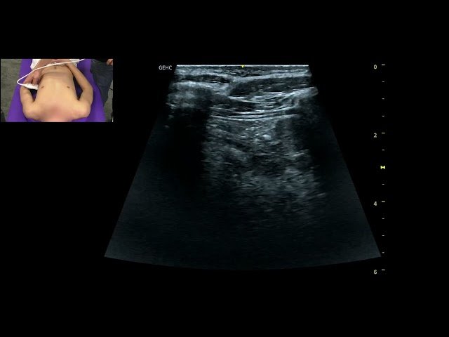 Comment Intégrer l'Échographie Pulmonaire à sa Consultation en Médecine Générale