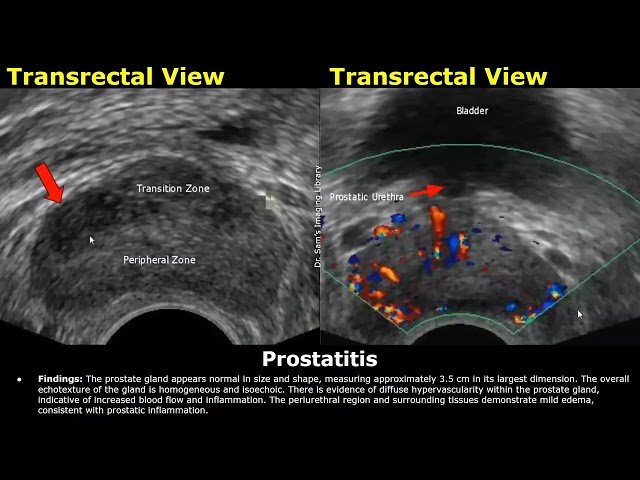 Prostate Ultrasound Reporting - How to Write USG Reports for BPH, Cancer, Cysts, and Calcifications
