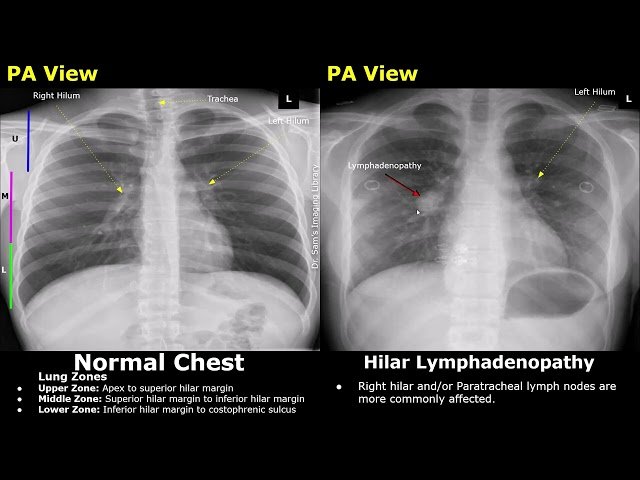 Chest X-Ray Lungs Normal vs Pulmonary Tuberculosis Imaging Findings - TB Radiography Cases and Images