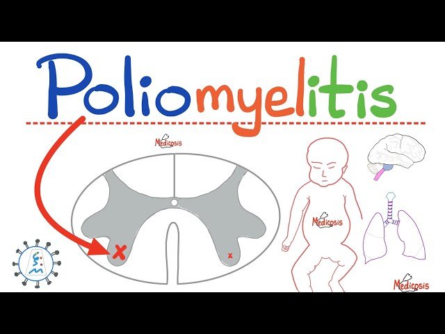 Poliomyelitis: Causes, Symptoms, and Neurological Effects