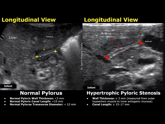 Stomach Ultrasound Normal vs Abnormal - Antrum and Pylorus Scan - Pediatric and Adult Gastric USG Cases