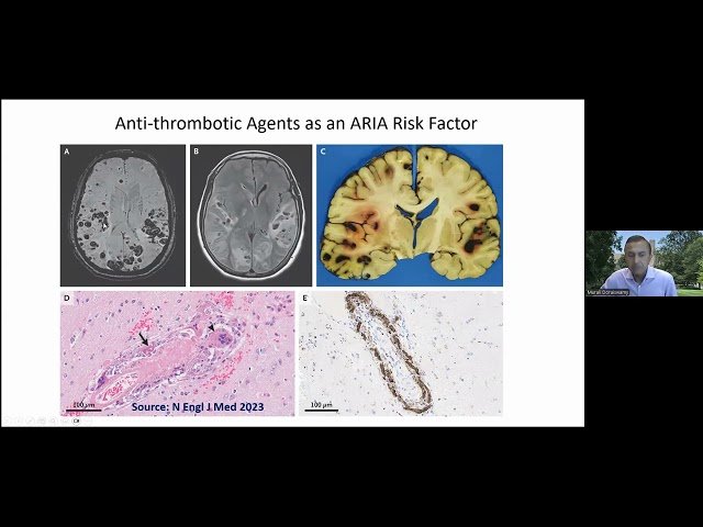 Prevalence and Predictors of ARIA in the Real World