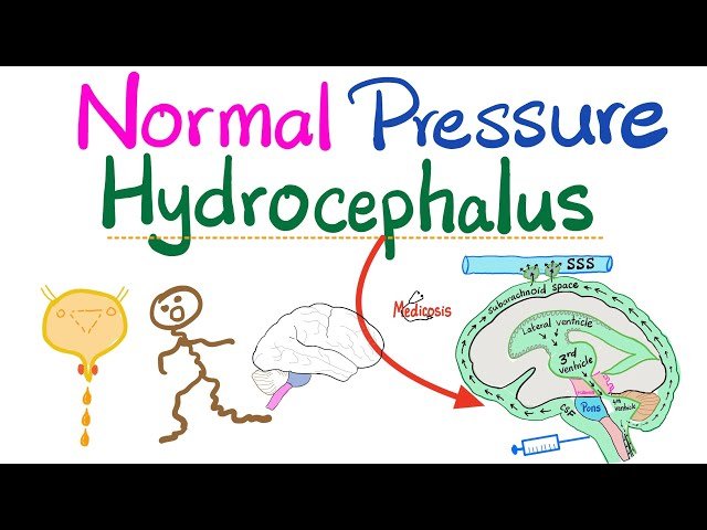 Normal Pressure Hydrocephalus - Understanding Symptoms and Neurological Impact
