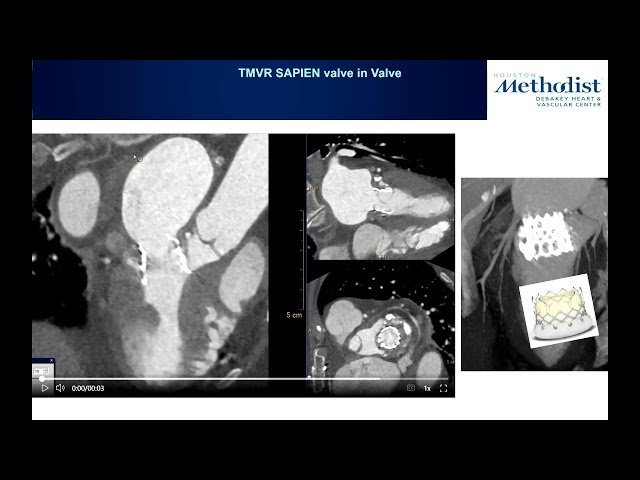 Evaluation of Prosthetic Mitral Valve Function - MMI Conference