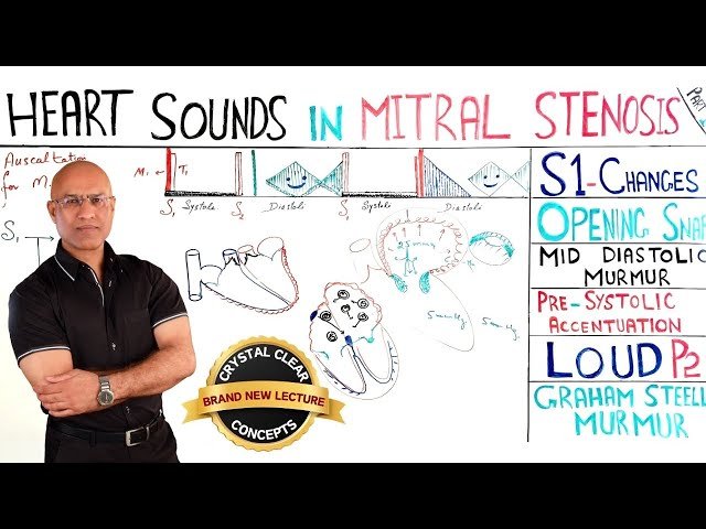 Heart Sounds and Clinical Manifestations in Mitral Stenosis - Session 1