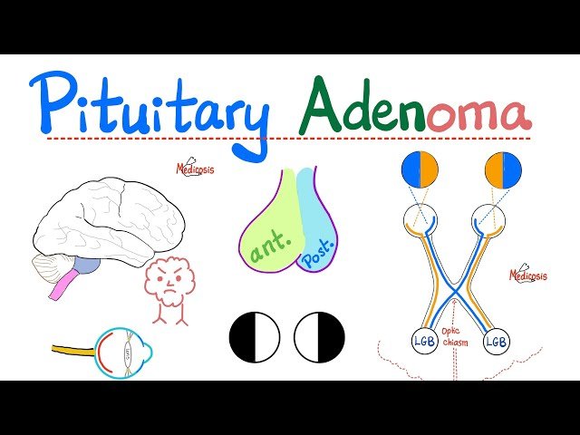 Pituitary Adenomas and Tumors: Understanding Micro and Macroadenomas and Visual Field Effects